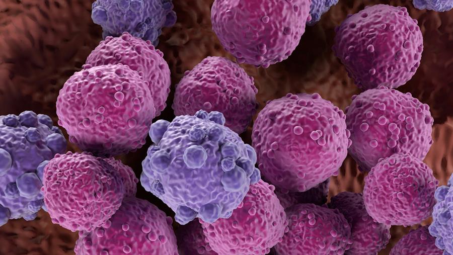 Lymphomes à grandes cellules B : une immunothérapie associée au R-CHOP retarde la progression